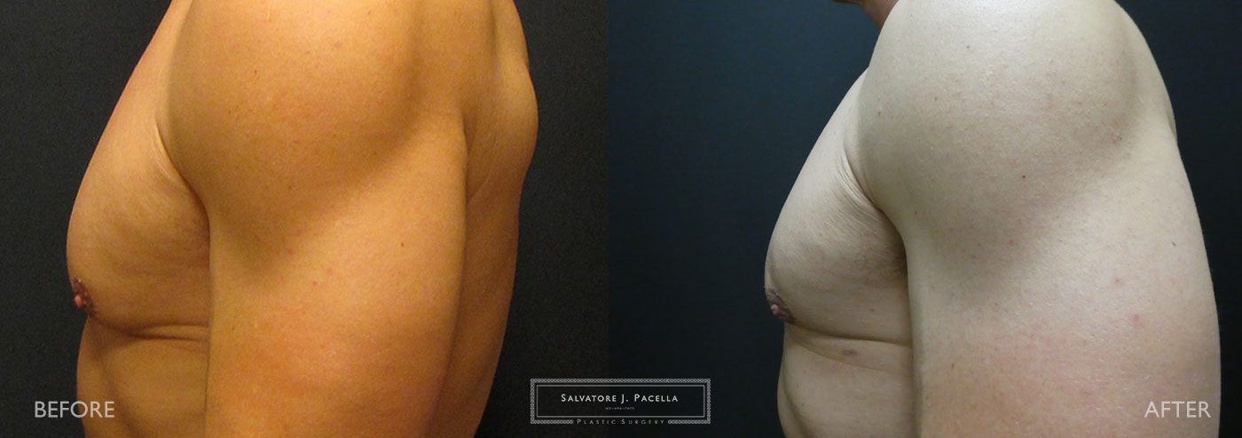 Breast Reduction for Men Archives - Salvatore J. Pacella, Board-Certified  Plastic Surgeon